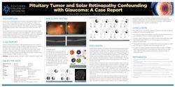 Pituitary Tumor and Solar Retinopathy Confounding with Glaucoma A Case Report